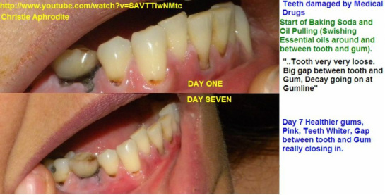 Oil Pulling Cavity Before And After